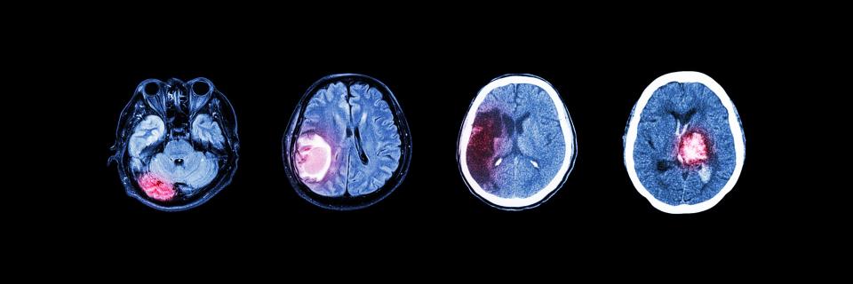Oncologie - tumeurs cérébrales
