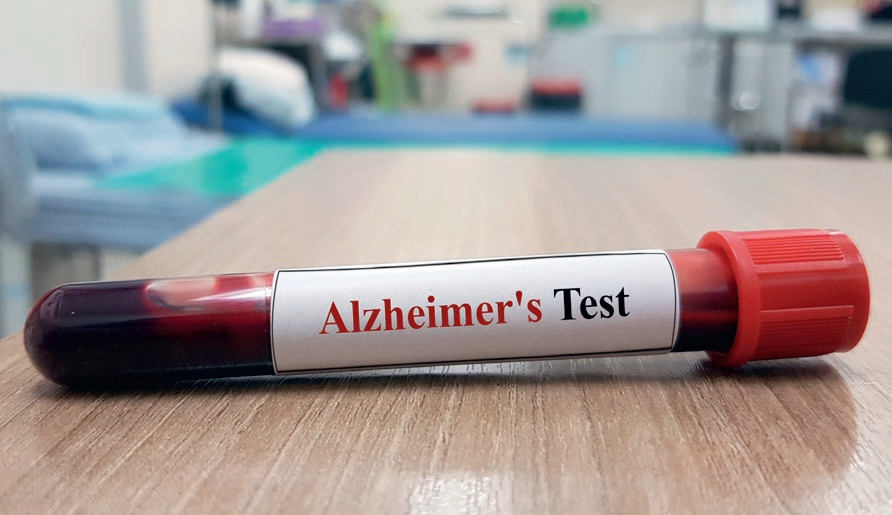 Les biomarqueurs sanguins d’alzheimer pourraient grandement simplifier le diagnostic et en réduire le coût - © joel bubble ben-Shutterstock.com
