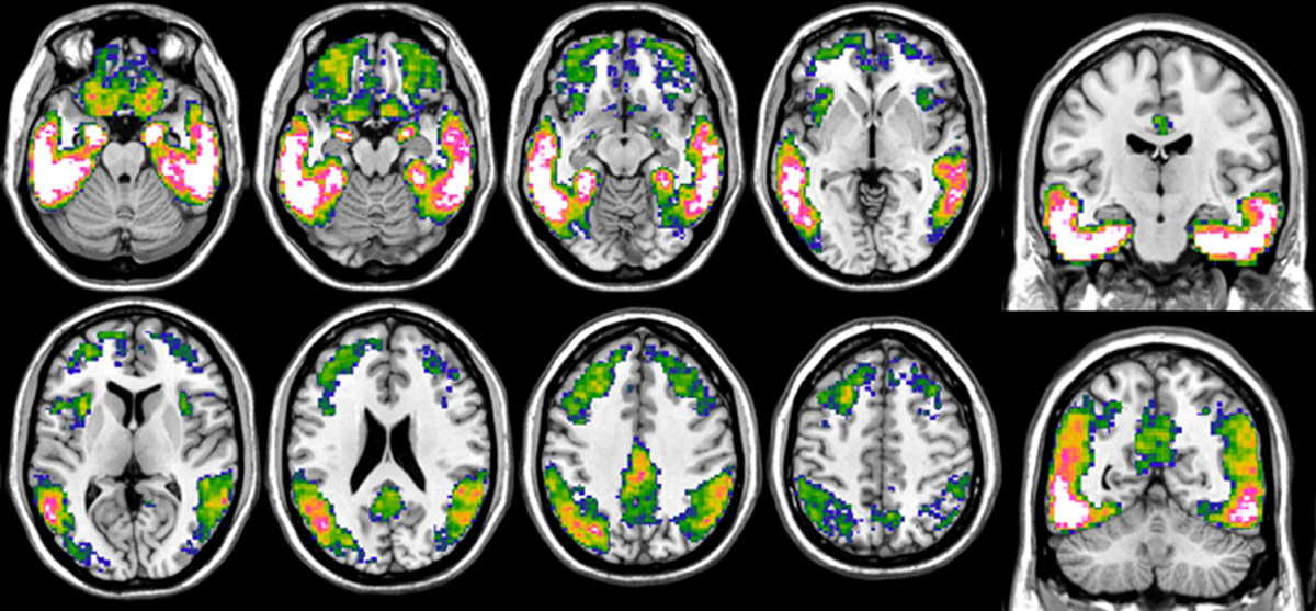 Imaging of the brains of Alzheimer's patients