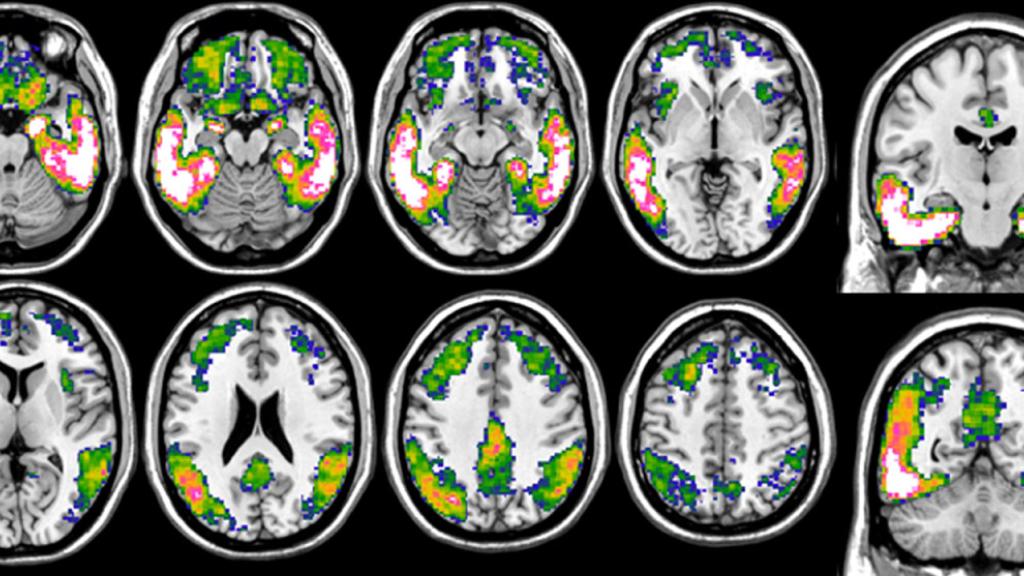 Imaging of the brains of Alzheimer's patients