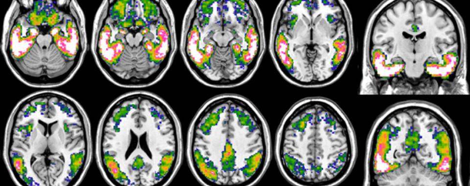 Imagerie de cerveaux de patient-es atteint-es de la maladie d'Alzheimer
